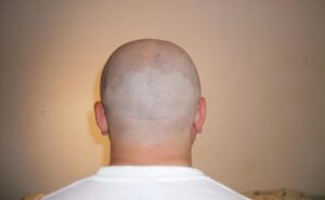 micropigmentation scalp treatment