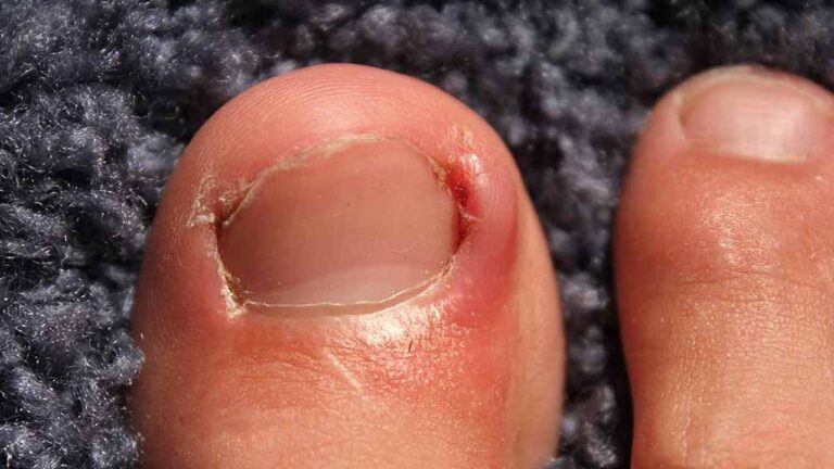 Toenail Removal in Singapore