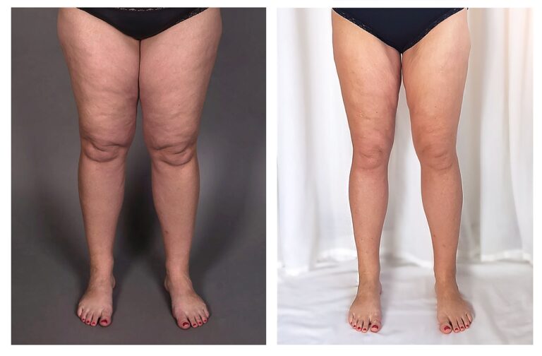 Lipedema