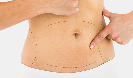 Tummy Tuck